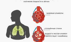 Что такое острый респираторный дистресс-синдром у взрослых и как он возникает: причины и симптомы