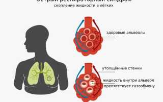 Что такое острый респираторный дистресс-синдром у взрослых и как он возникает: причины и симптомы
