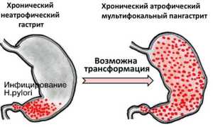 Атрофический гастрит желудка: причины, симптомы и лечение для здоровья