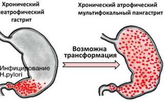 Атрофический гастрит желудка: причины, симптомы и лечение для здоровья