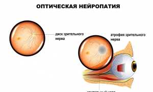 Атрофия зрительного нерва: симптомы и лечение, причины и профилактика