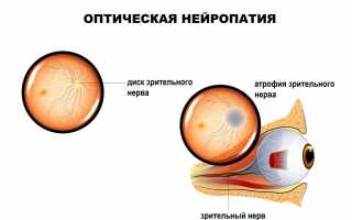 Атрофия зрительного нерва: симптомы и лечение, причины и профилактика