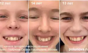 Когда начинать исправление прикуса у детей и зачем это важно