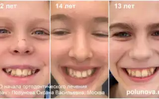 Когда начинать исправление прикуса у детей и зачем это важно