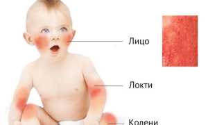 Проявления пищевой аллергии, её признаки и симптомы у детей