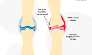 Хруст в коленях при приседаниях. О чем пытаются сообщить ваши ноги? Узнайте причины и советы