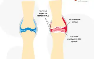 Хруст в коленях при приседаниях. О чем пытаются сообщить ваши ноги? Узнайте причины и советы