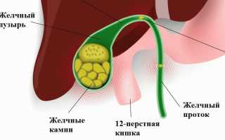 Живут ли с камнями в желчном пузыре и обязательна ли операция для здоровья?