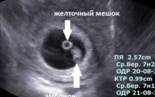 Нет эмбриона в плодном яйце 7 недель