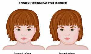 Болеют ли взрослые эпидемическим паротитом (свинкой) в наше время?