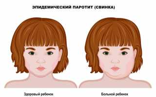 Болеют ли взрослые эпидемическим паротитом (свинкой) в наше время?