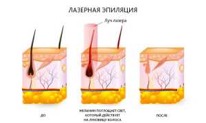 Вредна ли лазерная эпиляция для здоровья, побочные эффекты и рекомендации