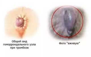 Острый геморроидальный тромбоз: что о нем нужно знать для здоровья?
