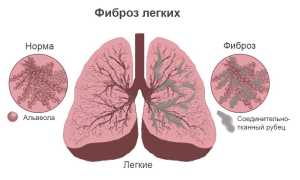 Что такое COVID-19 и ковидная пневмония: опасность и последствия здоровья