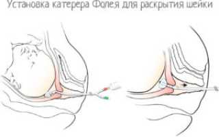 Катетер перед родами для стимуляции