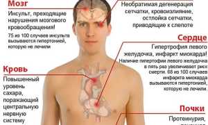 Что такое гипертонический криз, последствия для здоровья и его лечение