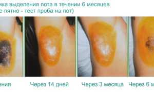 Можно ли вылечить гипергидроз уколами ботокса? Эффективность, противопоказания и отзывы