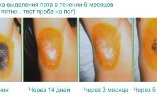Можно ли вылечить гипергидроз уколами ботокса? Эффективность, противопоказания и отзывы