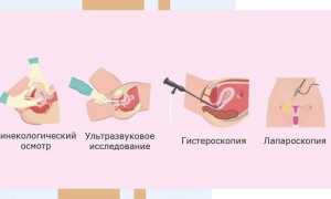 Разрыв кисты яичника (апоплексия): причины, последствия и лечение