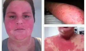 Фоточувствительность кожи и лекарства. Почему нужно избегать солнца при приеме этих препаратов для здоровья?