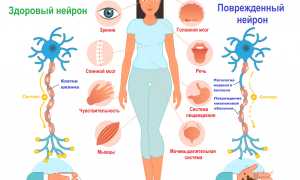 Рассеянный склероз: причины заболевания, прогноз жизни и лечение