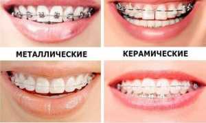 Зубные брекеты для детей: что лучше всего ставить, с какого возраста и почему?