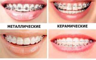 Зубные брекеты для детей: что лучше всего ставить, с какого возраста и почему?
