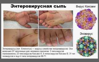 Сыпь при вирусных инфекциях: виды, как появляется и как её лечить, особенности и рекомендации