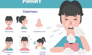 Аллергический ринит: симптомы и лечение у взрослых