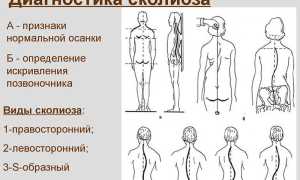 Как исправить сколиоз? Поможет комплекс из 7 упражнений для здоровья