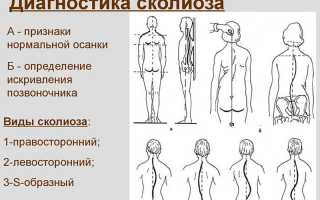 Как исправить сколиоз? Поможет комплекс из 7 упражнений для здоровья