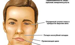 Что такое микроинсульт и как его распознать: важные аспекты здоровья