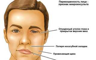 Что такое микроинсульт и как его распознать: важные аспекты здоровья