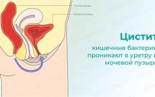 Секс во время цистита: разрешен или нет? Важные советы