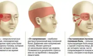 Болит голова во время тренировок: с чем это связано и как лечить? Полезные советы