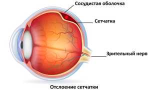 Типы отслоения сетчатки глаза и способы лечения: важные аспекты и рекомендации