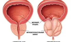 Типы простатита. Что о нем нужно знать мужчинам для здоровья