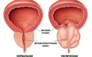 Типы простатита. Что о нем нужно знать мужчинам для здоровья