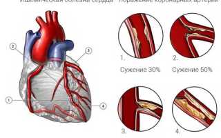 Как проявляется ишемическая болезнь сердца? Полное руководство