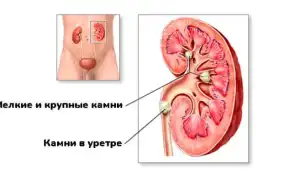 Камни в почках — признаки и симптомы, которые нельзя игнорировать