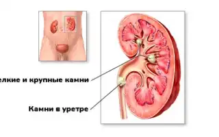 Камни в почках — признаки и симптомы, которые нельзя игнорировать