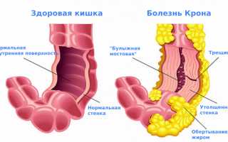 Что такое болезнь Крона и как её лечить? Полное руководство
