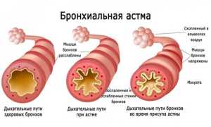 Свистящее дыхание у детей: почему оно возникает, это астма и что с этим делать?