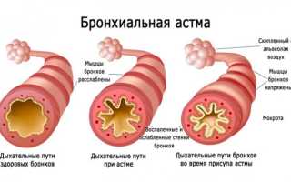 Свистящее дыхание у детей: почему оно возникает, это астма и что с этим делать?