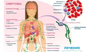 Как проявляется 4 стадия лимфомы? Полное руководство по симптомам