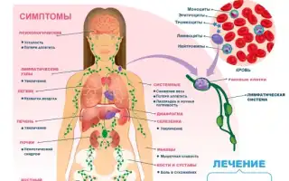 Как проявляется 4 стадия лимфомы? Полное руководство по симптомам