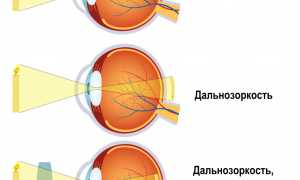 Дальнозоркость: основные симптомы и лечение для здоровья глаз