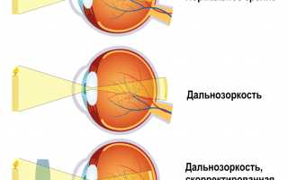 Дальнозоркость: основные симптомы и лечение для здоровья глаз