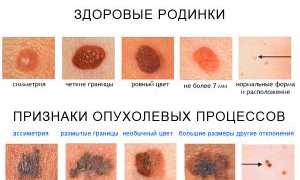 Как выявить начальную стадию рака кожи: симптомы и признаки для диагностики