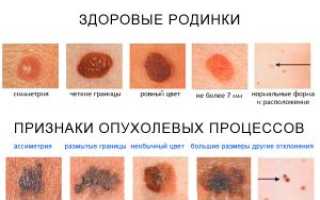 Как выявить начальную стадию рака кожи: симптомы и признаки для диагностики